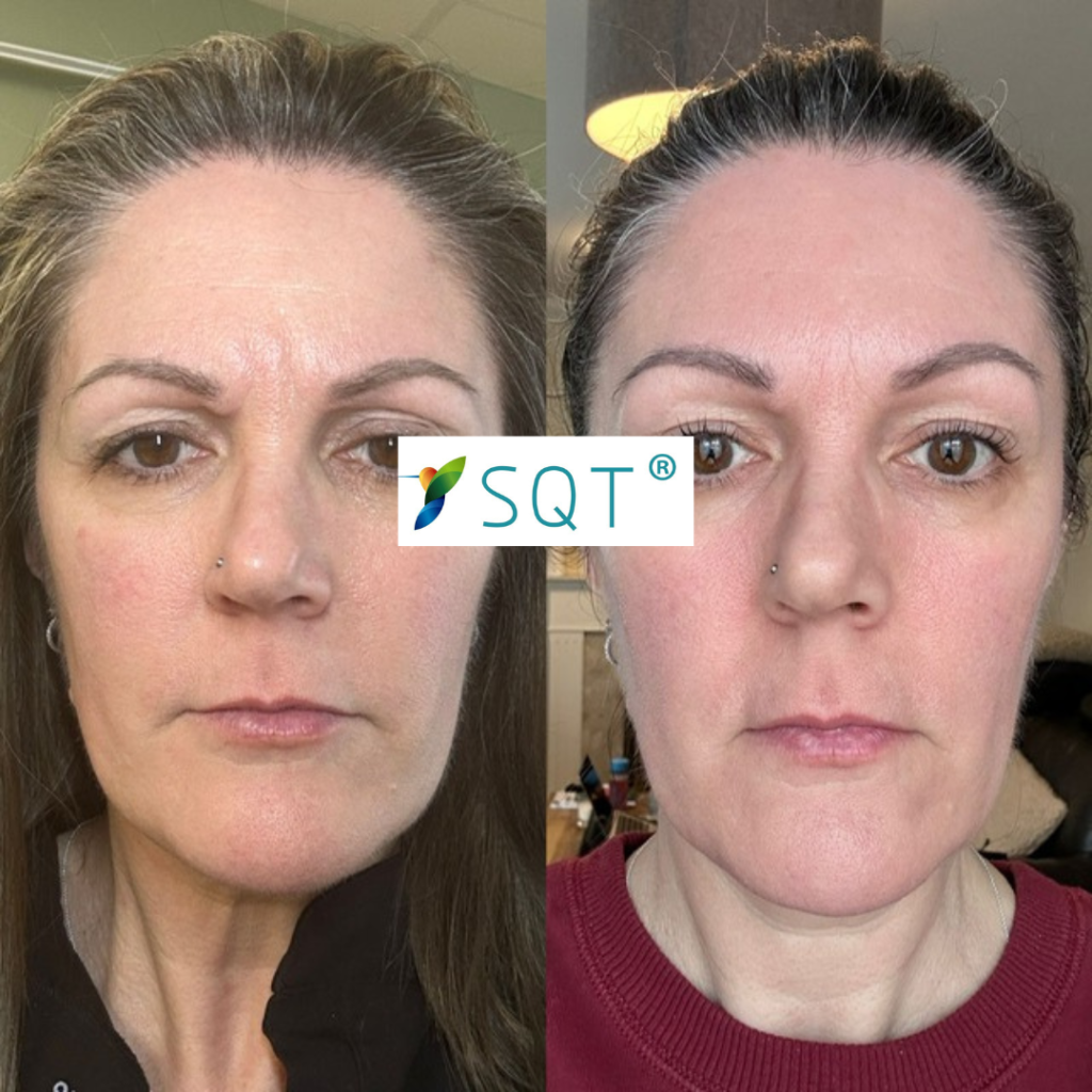 SQT UK Bio Microneedling SQT UK