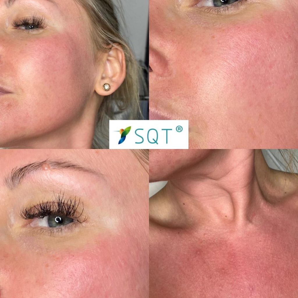 SQT UK Bio Microneedling SQT UK